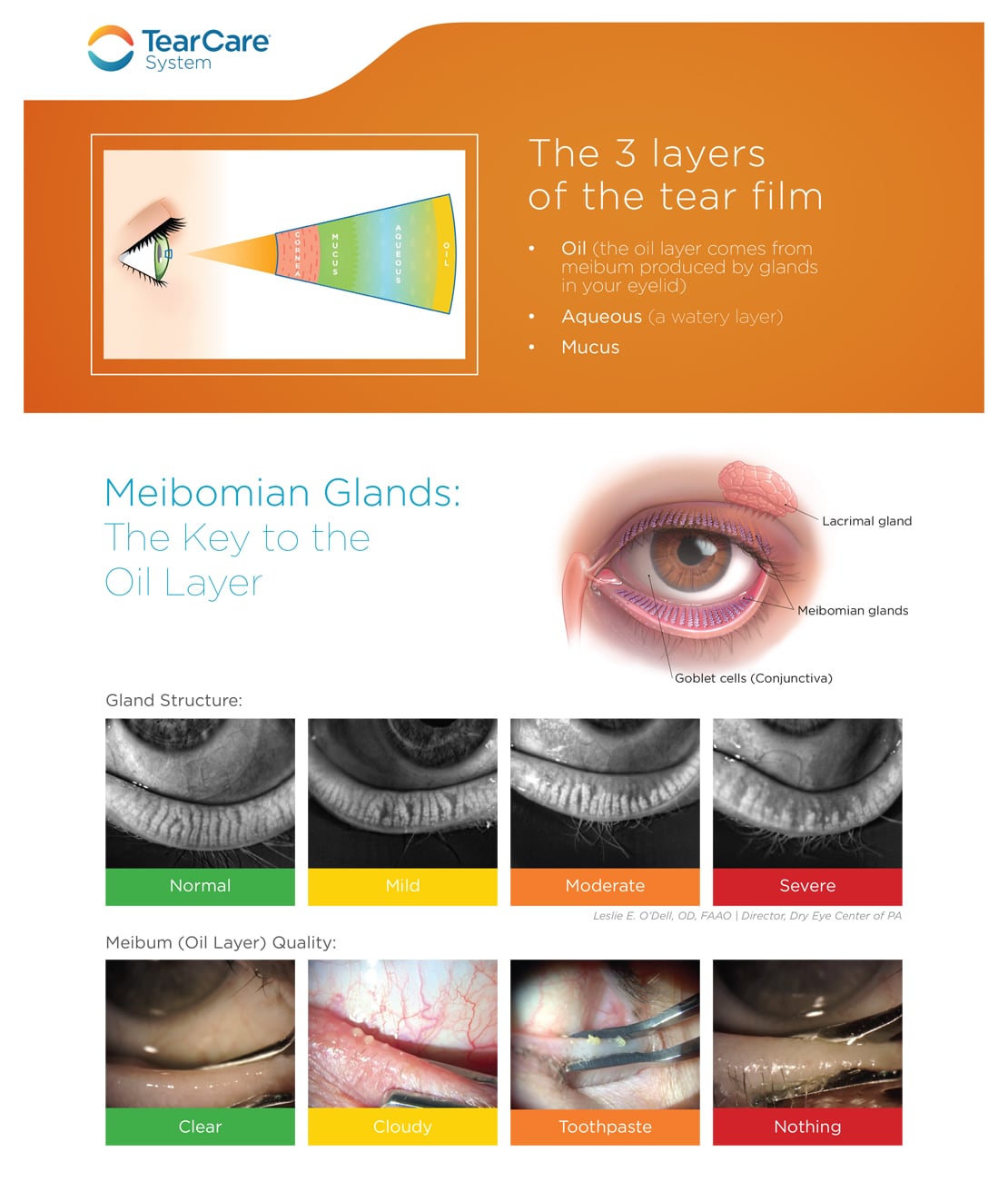 meibomian gland dysfunction expression